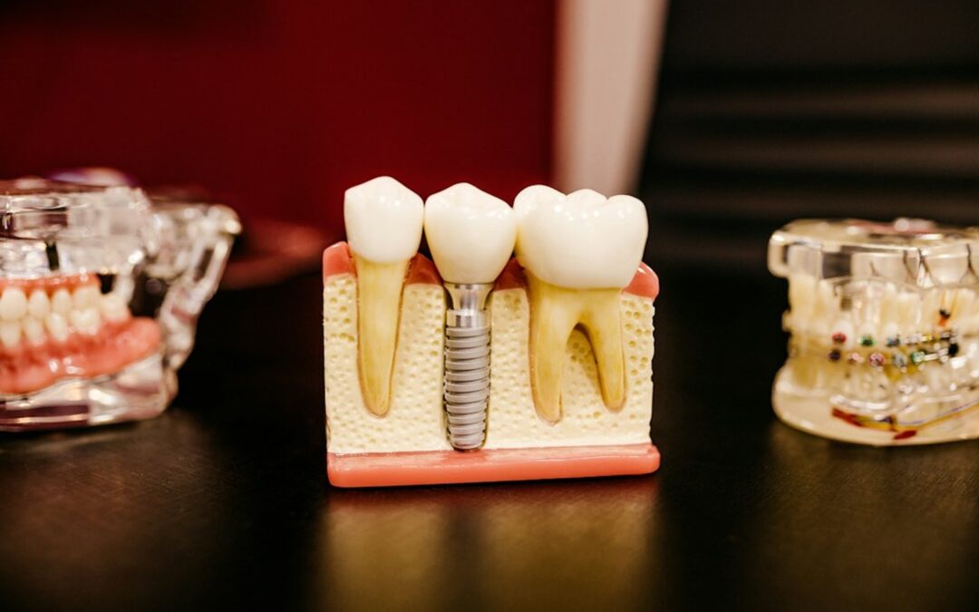 Wyrwanie zęba i co dalej? Kiedy można wszczepić implant?