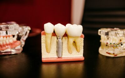 Wyrwanie zęba i co dalej? Kiedy można wszczepić implant?